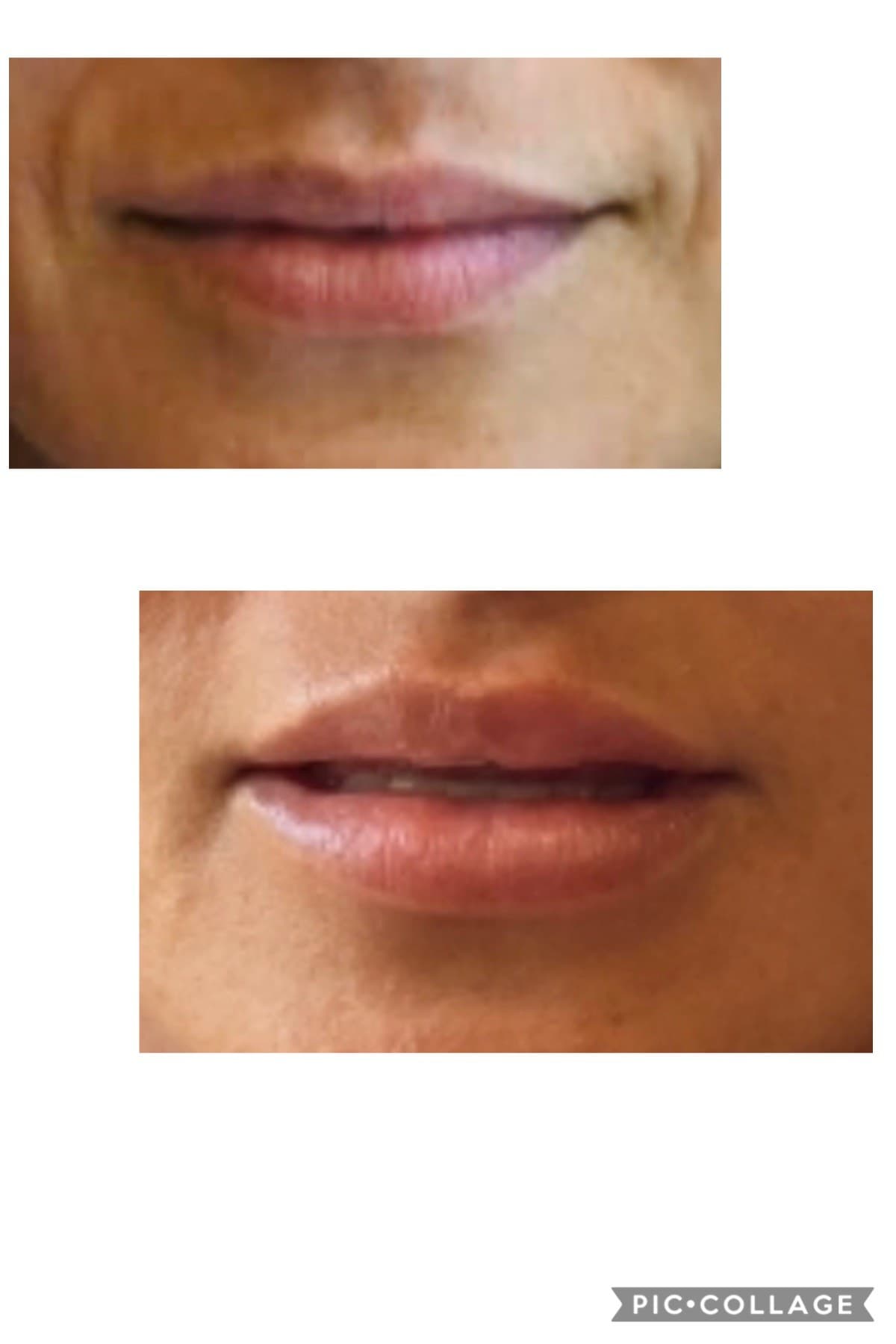 Lips before and after — real Healinque patient, shared with written consent