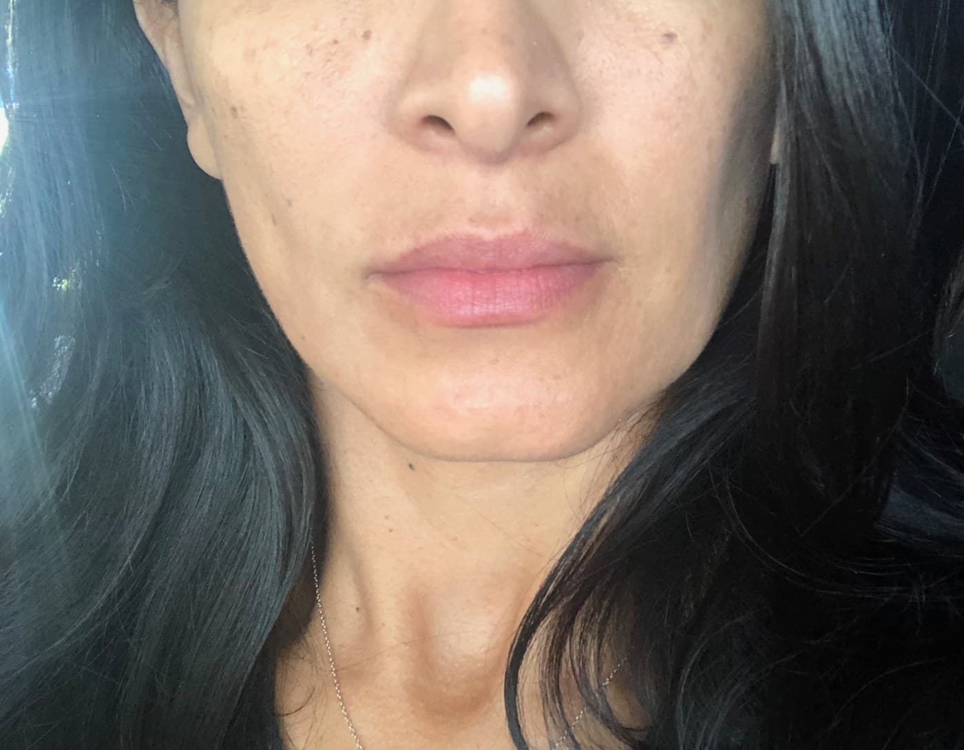 Lips before and after — real Healinque patient, shared with written consent