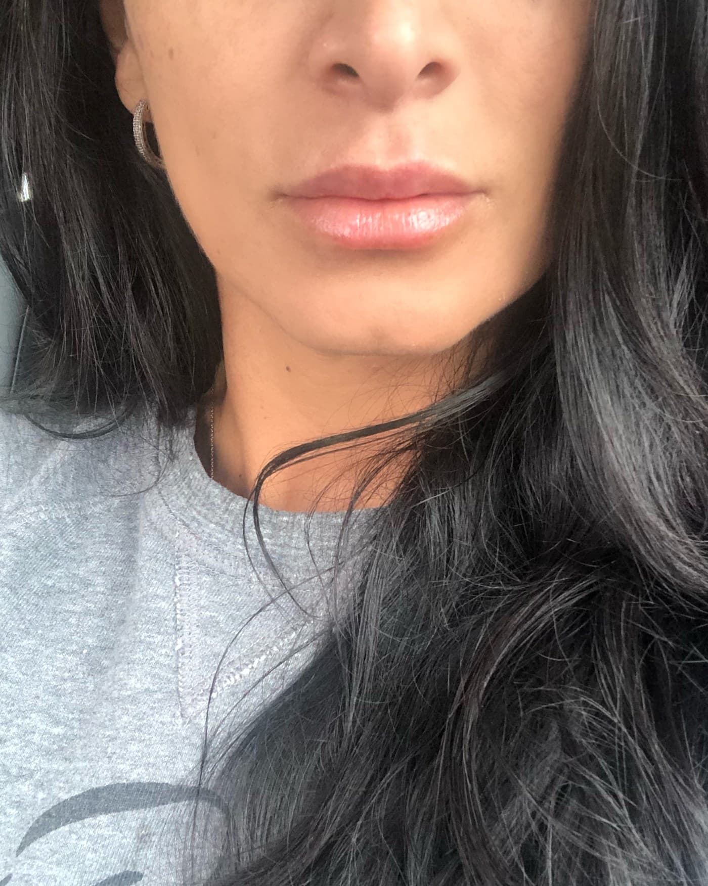 Lips before and after — real Healinque patient, shared with written consent